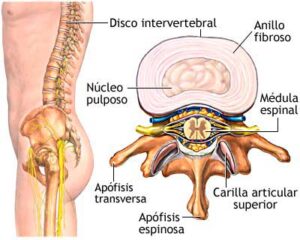 Fisioterapia Y Hernia Discal Avanfi