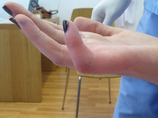 Artrolisis Ecoguiada de los dedos para quitar la rigidez de los mismos