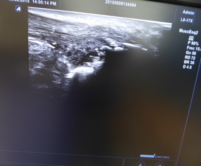 Enfermedad Haglund II - Avanfi. Cirugía Ecoguiada Ultramis