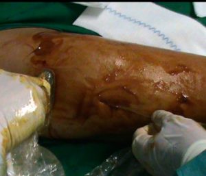 Sindrome-Cicatricial-adherencial