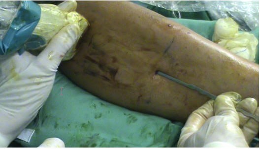 Sindrome Cicatricial adherencial. Avanfi. Cirugía Ecoguiada