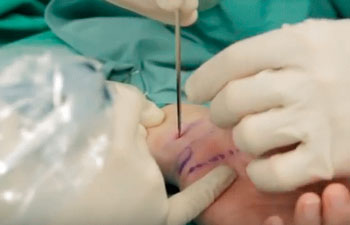 Los ecógrafos de alta resolución facilitan la cirugía y la curva de aprendizaje de los cirujanos, reduciendo las complicaciones en la Cirugía Ecoguiada Túnel del Carpo