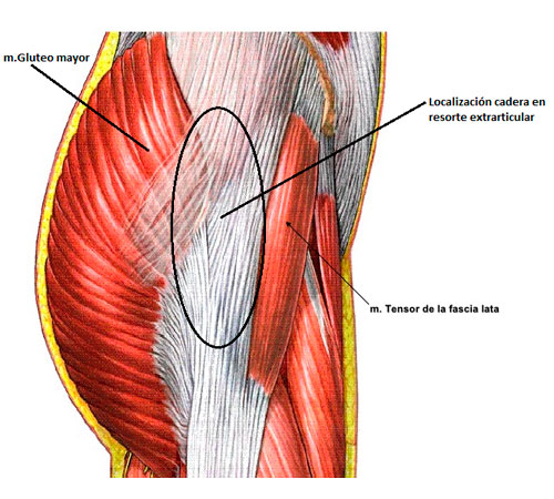 Tendinitis en el tensor de la fascia lata Tendinitis en el tensor de la fascia lata