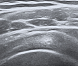 Tendinitis Calcificante del Hombro 3 Tendinopatia del manguito rotador