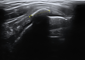 Tendinitis Calcificante del Hombro extracción de la calcificación