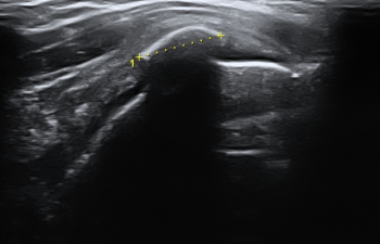 Tendinitis Calcificante del Hombro Tendinitis Calcificante del Hombro extracción de la calcificación