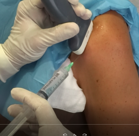 Tendinitis Calcificante del Hombro extracción de la calcificación con aguja