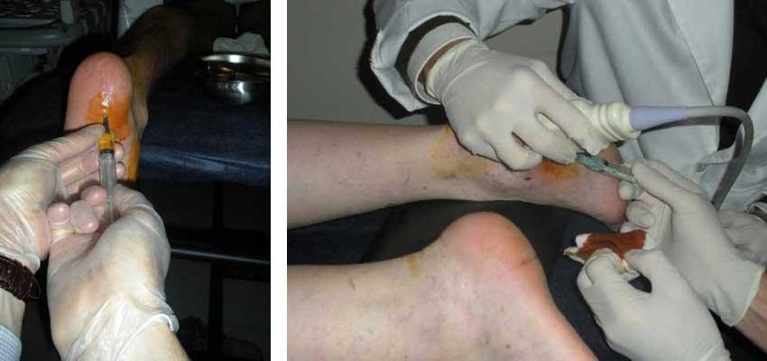 Tratamiento Ecoguiado con Plasma Rico Factores de Crecimiento PRP para la Fascitis bilateral