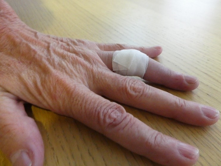 Artrolisis Ecoguiada de Artritis de la mano