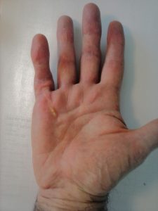Artrolisis Ecoguiada de Artritis de la mano