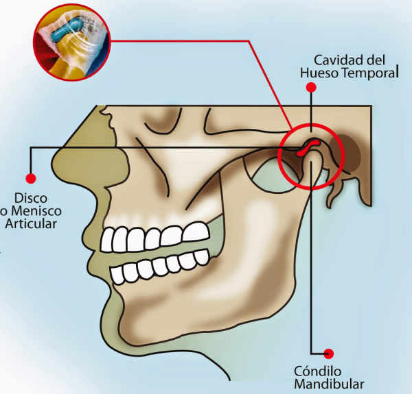 ¿Qué mecanismo produce el dolor en la articulación temporomandibular?