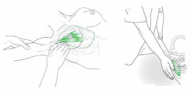 fisioterapia para la tendinitis del manguito rotador
