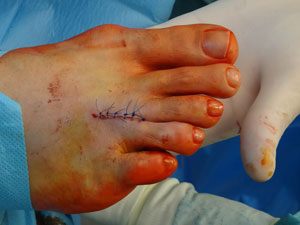 Cicatriz de la Cirugía Ecoguiada del Neuroma de Morton con Cirugía abierta
