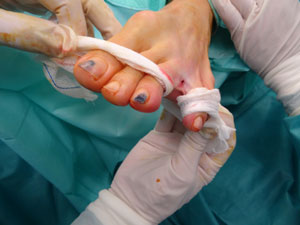 Cicatriz de la Cirugía Ecoguiada del Neuroma de Morton con Cirugía ecoguiada ultramínimamente invasiva