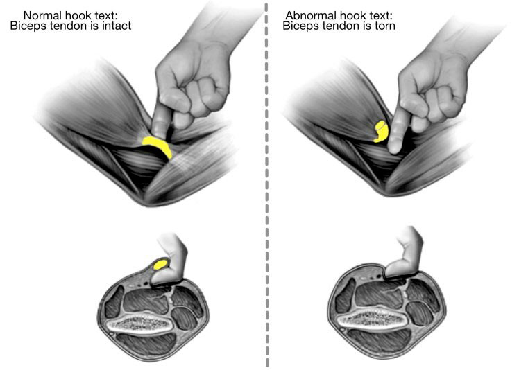 Hook Test: rotura distal del tendón del bíceps braquial en la epicondilitis