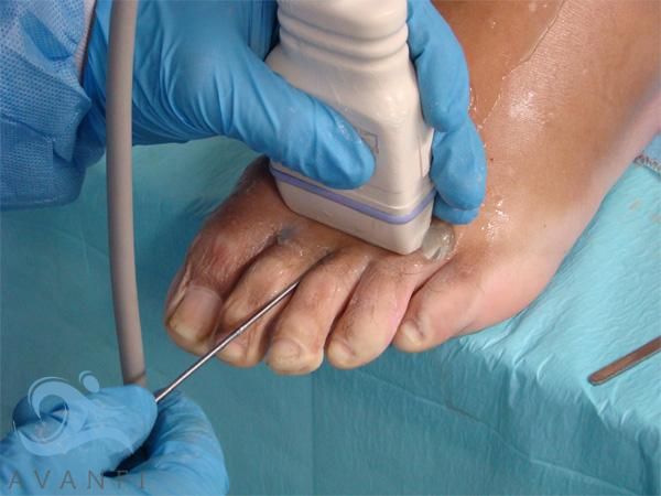 Testimonio Cirugia Ecoguiada del Neuroma de Morton