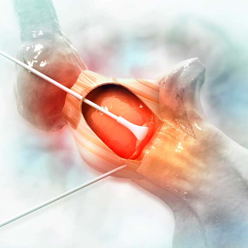 especialistas-en-prótesis-de-rodilla y cirugías complejas de rodilla
