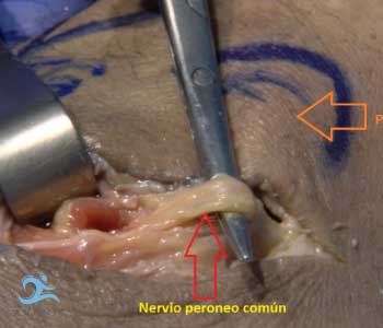 cirugía ecoguiada del atrapamiento del nervio peroneo común