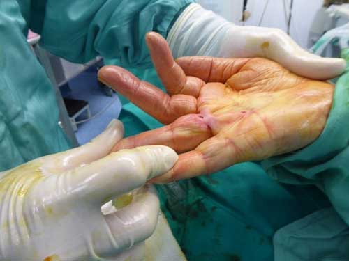 Tratamiento quirúrgico de los dedos en gatilloen