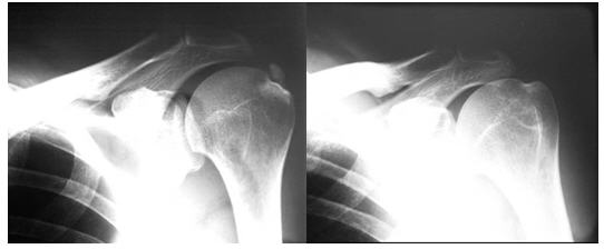 calcificación del hombro tipo I de Gärtner y mediana de Bosworth. Antes y después del tratamiento con aspiración ecoguiada. 