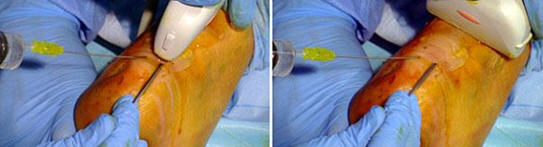 Operación de una tendinosis no insercional del Aquiles mediante cirugía ultramínimamente invasiva ecoguiada