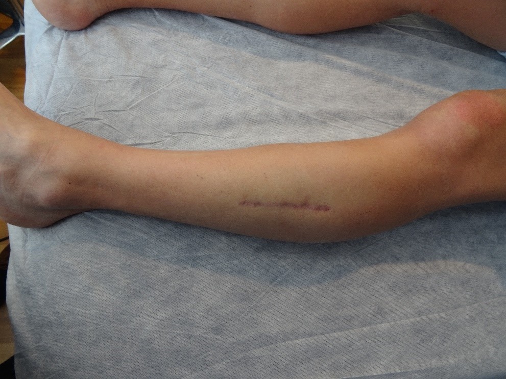 Cicatriz de cirugía convencional abierta, con isquemia, con puntos, con anestesia completa de la extremidad por síndrome del compartimental. 
