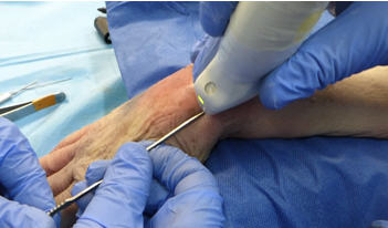 La cirugía ecoguiada del síndrome de intersección de la muñeca permite hacer una liberación quirúrgica del segundo compartimento extensor