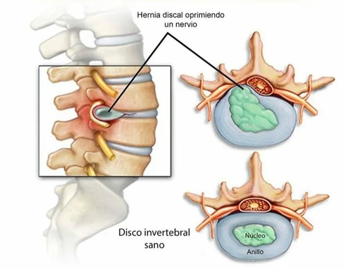 Causas de la dorsalgia o dolor dorsal