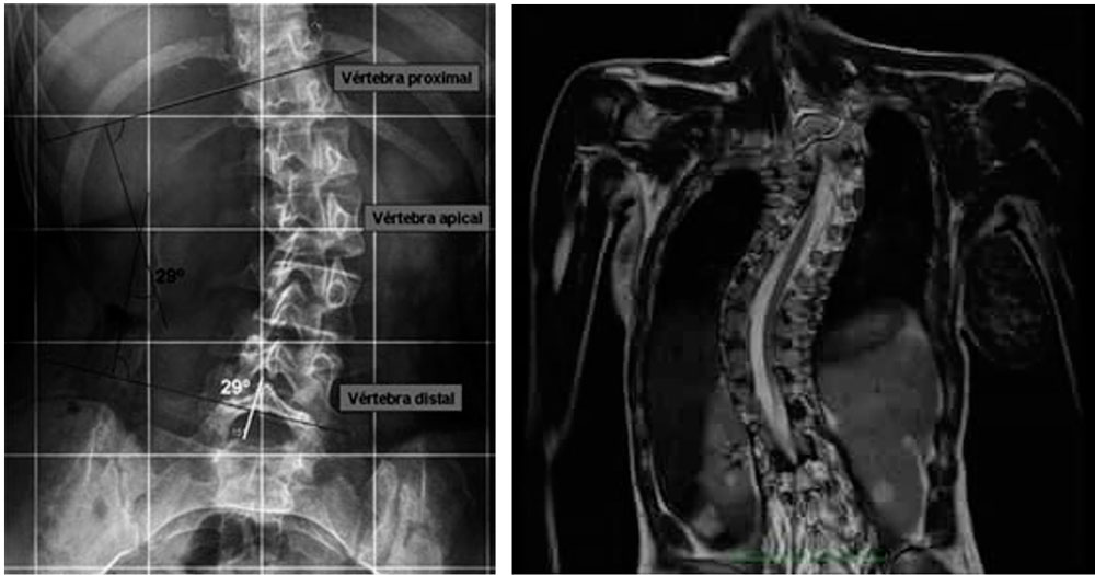 Radiografía de un paciente con escoliosis