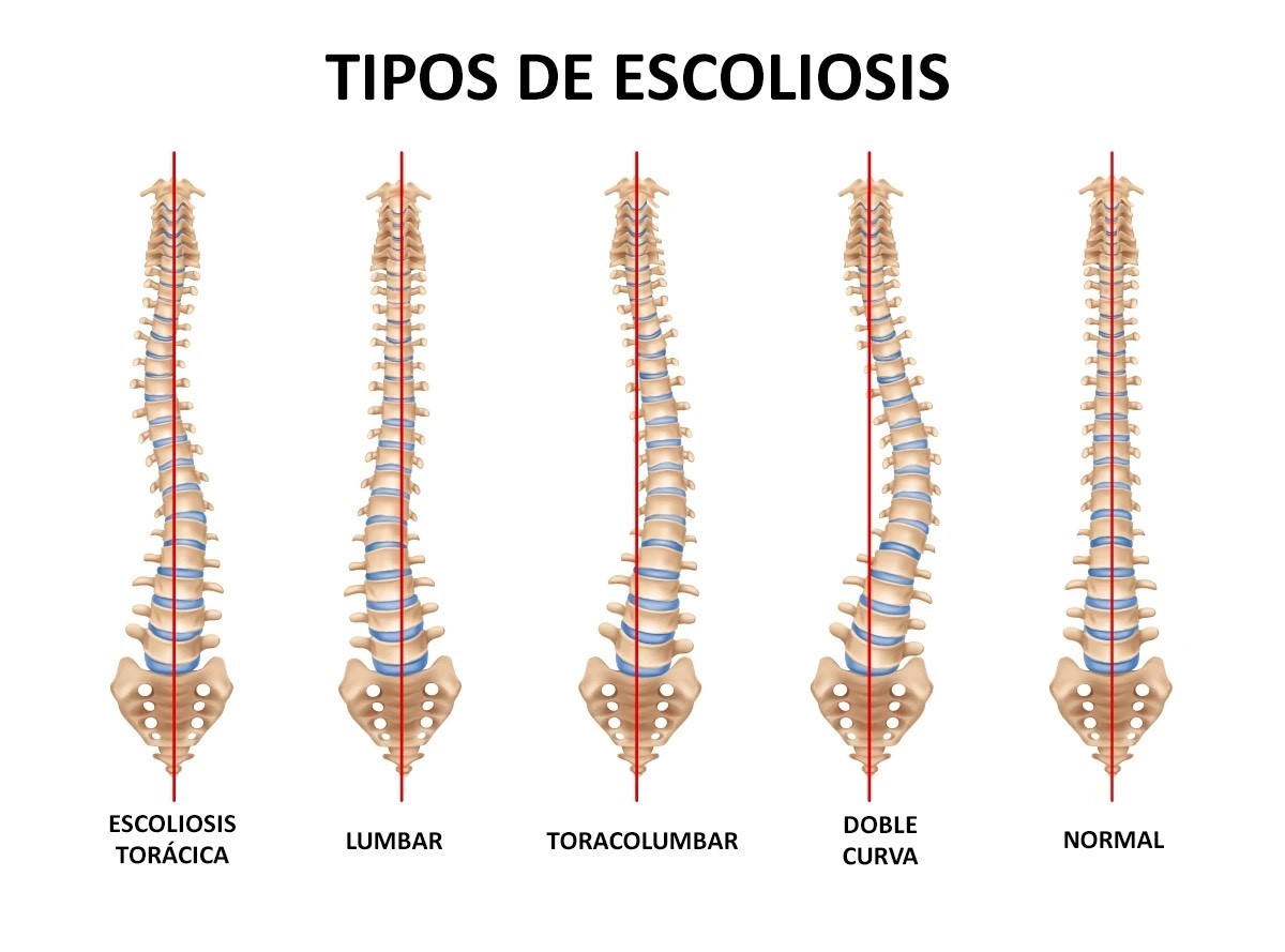 Tipos de escoliosis según la curvatura y deformidad