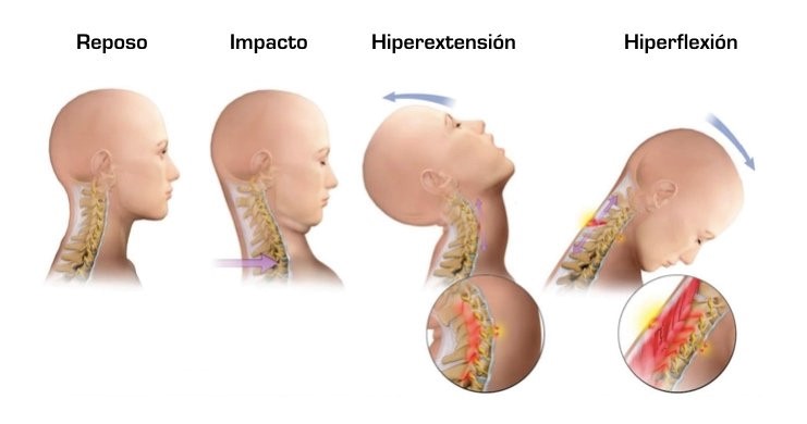 ¿Qué es el esguince o latigazo cervical?