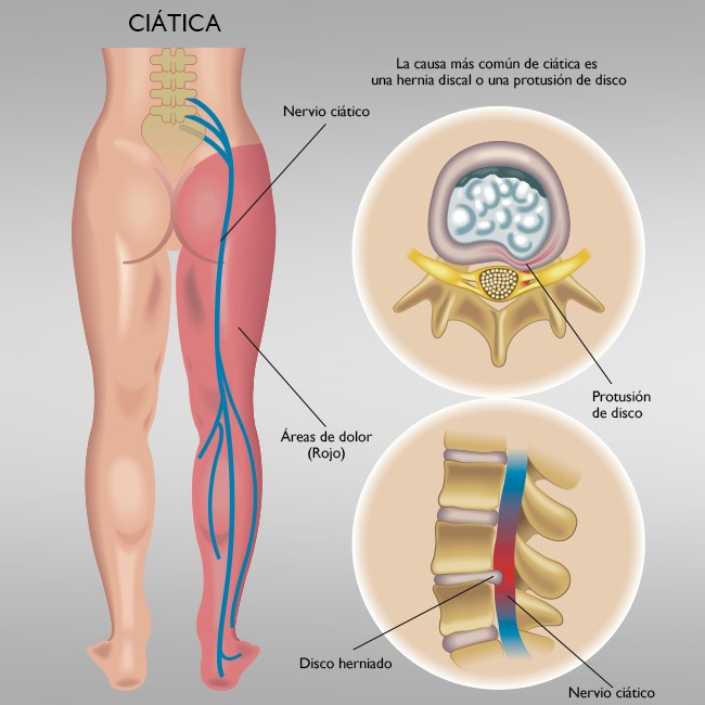 Cómo nos afecta una hernia discal