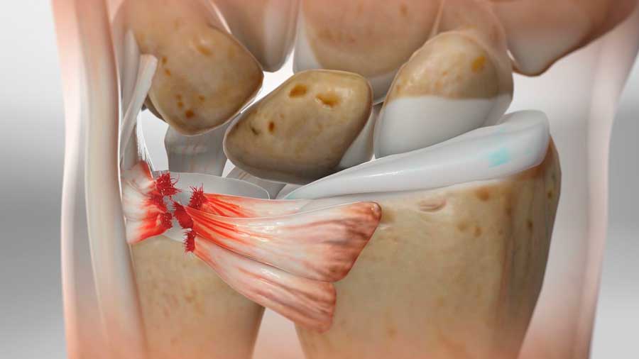 Fisioterapia para la Rotura Fibrocartílago Triangular