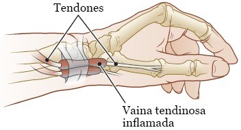 La tenosinovitis de De Quervain