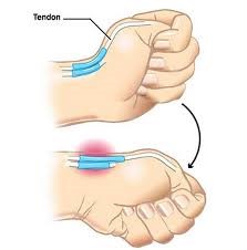 Síntomas de la tenosivitis de De Quervain