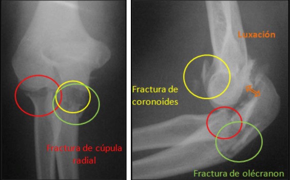 Tratamiento con fisioterapia de la triada terrible de codo