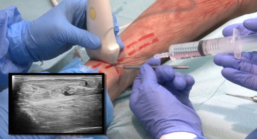 Imagen intraoperatoria de tratamiento tenotomía del delgado plantar con cirugía ecoguida en paciente real. Visión ecográfico en paraleleo