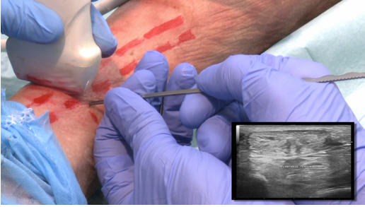 Imagen intraoperatoria de tratamiento tenotomía del delgado plantar con cirugía ecoguida en paciente real. Visión ecográfico en paraleleo